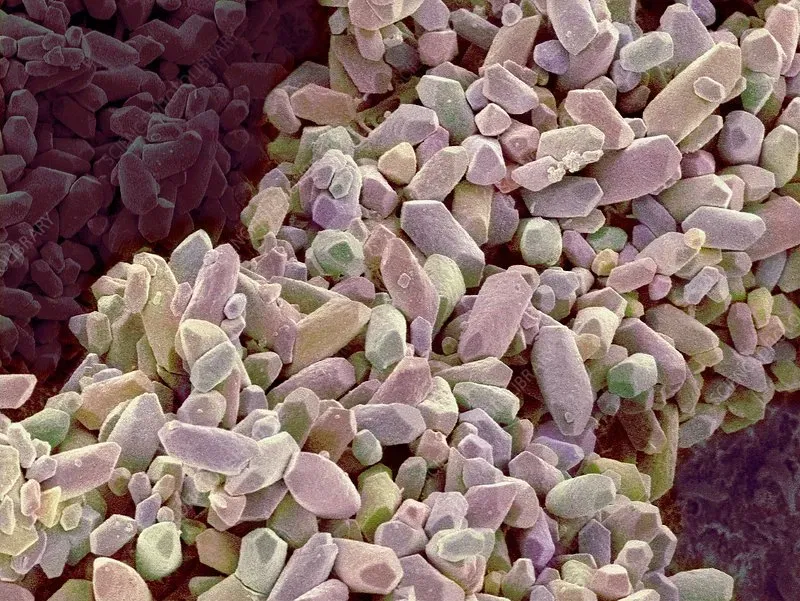 Crystals tai trong chính xác giải phẫu (otoconia/otolith) - Image 4