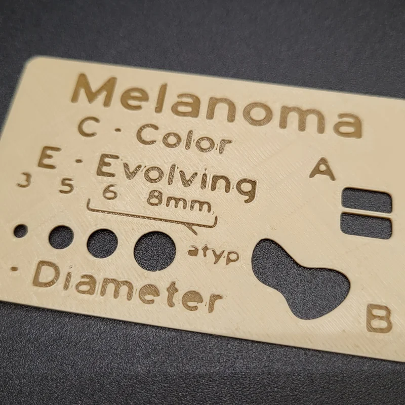 Thẻ Melanoma: Hỗ trợ nhận diện nốt ruồi bất thường