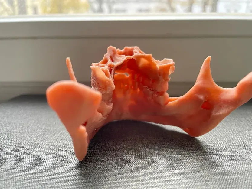 Hàm trên và hàm dưới sau phẫu thuật Bijaw - Image 1