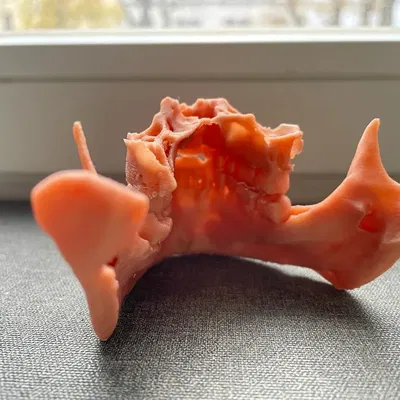 Hàm trên và hàm dưới sau phẫu thuật Bijaw