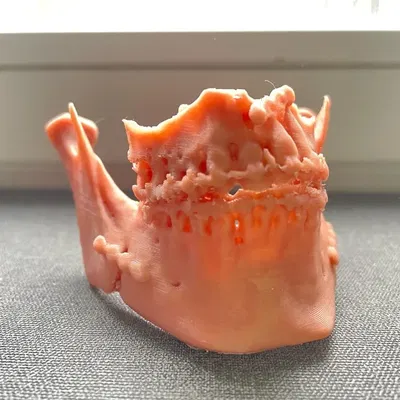 Hàm trên và hàm dưới sau phẫu thuật Bijaw