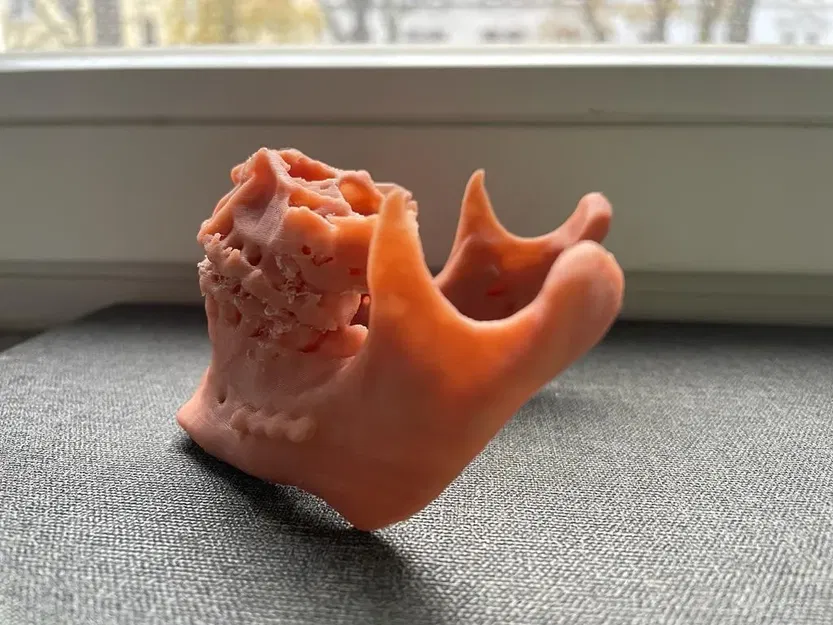 Hàm trên và hàm dưới sau phẫu thuật Bijaw - Image 3