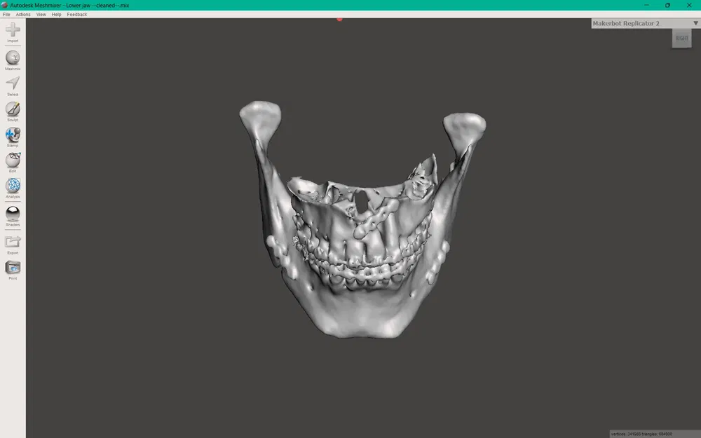 Hàm trên và hàm dưới sau phẫu thuật Bijaw - Image 4