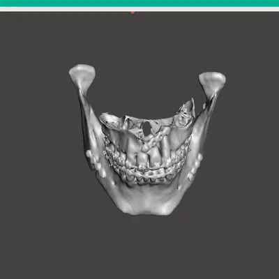 Hàm trên và hàm dưới sau phẫu thuật Bijaw