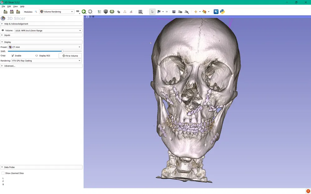 Hàm trên và hàm dưới sau phẫu thuật Bijaw - Image 5
