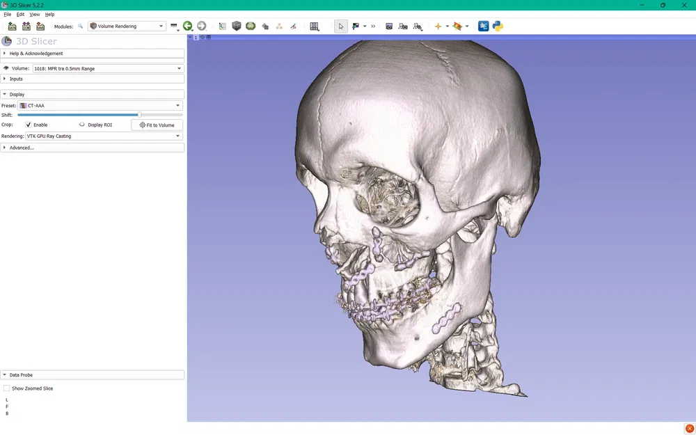 Hàm trên và hàm dưới sau phẫu thuật Bijaw - Image 6