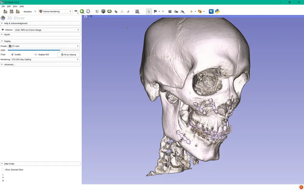 Hàm trên và hàm dưới sau phẫu thuật Bijaw - Image 7
