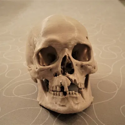 Hộp sọ người với chấn thương chiến tranh (bản quét 3D; Historiska Museet 260727)