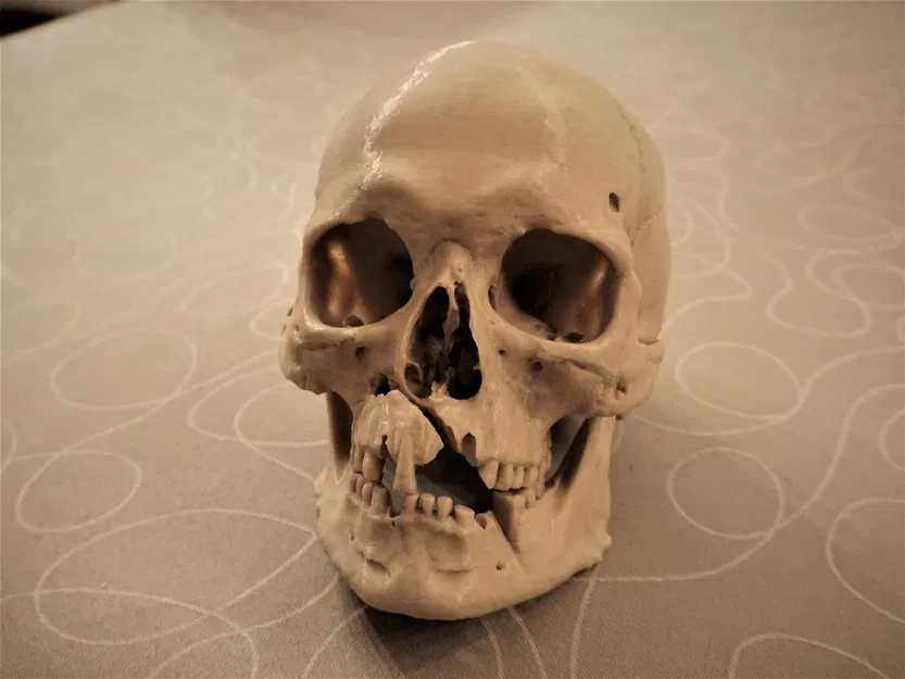 Hộp sọ người với chấn thương chiến tranh (bản quét 3D; Historiska Museet 260727) - Image 2