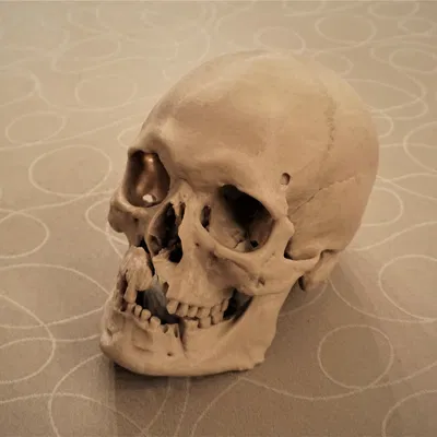 Hộp sọ người với chấn thương chiến tranh (bản quét 3D; Historiska Museet 260727)