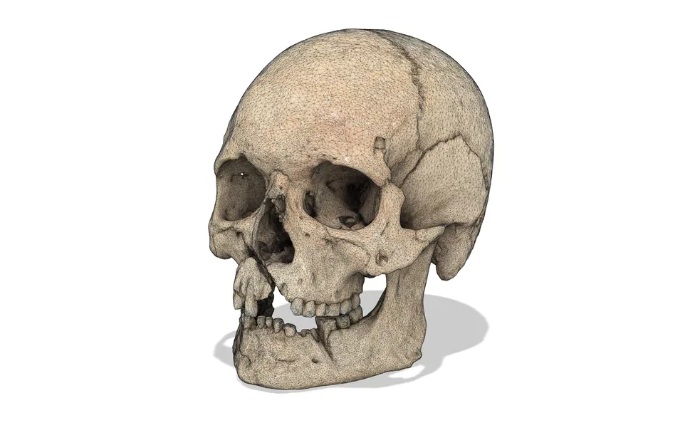 Hộp sọ người với chấn thương chiến tranh (bản quét 3D; Historiska Museet 260727) - Image 4