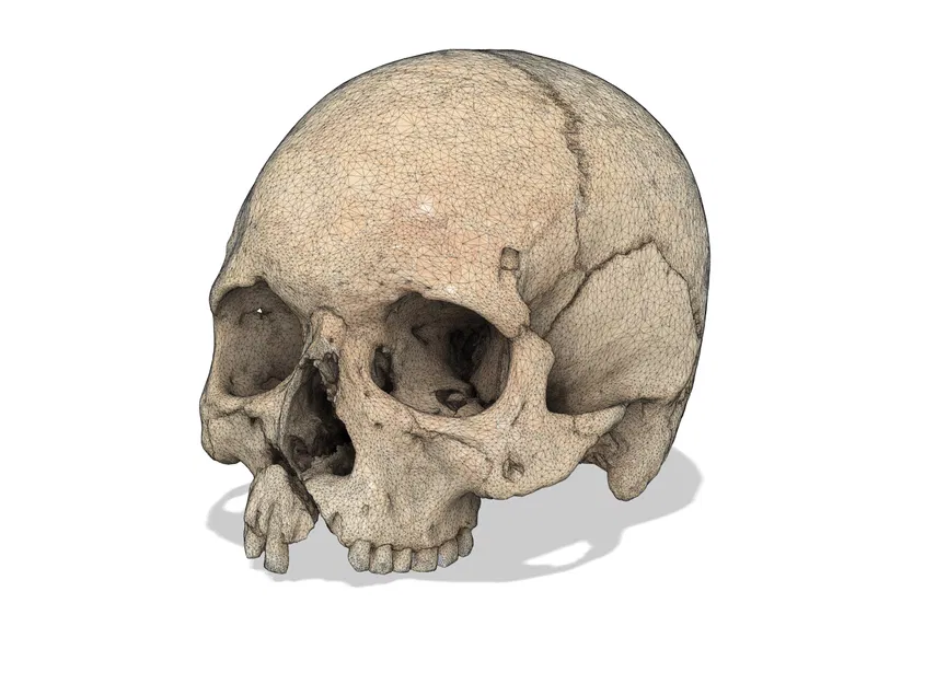 Hộp sọ người với chấn thương chiến tranh (bản quét 3D; Historiska Museet 260727) - Image 5