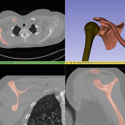 Xương Vai Phải - Mô Hình 3D Dễ In