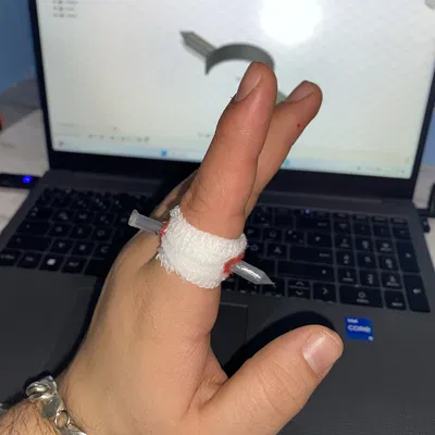 Móng Tay Xuyên Ngón Tay