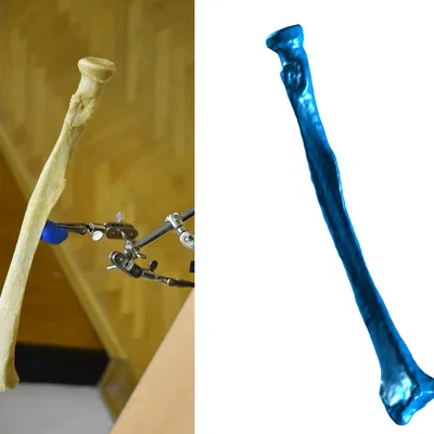 Quét 3D Xương Cẳng Tay - Xương Trụ
