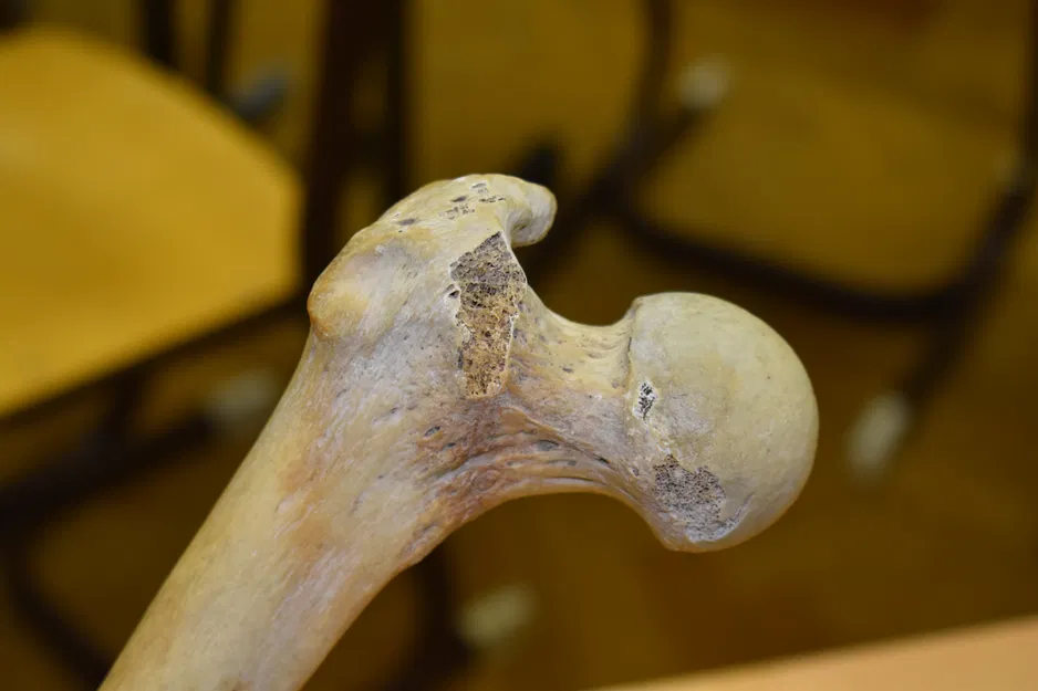 Xương Đùi (Femur) Quét 3D - Image 3