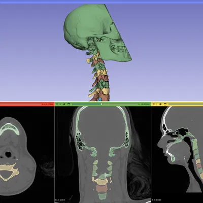 Mô hình Xương Cổ Cứng (Rigid Spine)