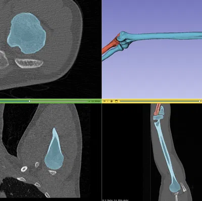 Xương Tay Trên Trái (Humerus Left)