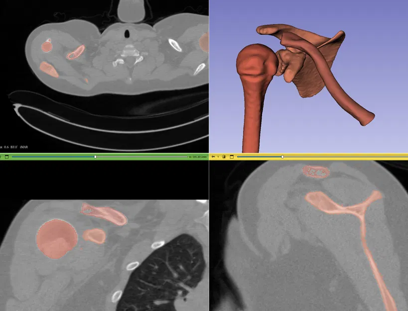 Xương Đòn Trái (Clavicle Left) - Image 2
