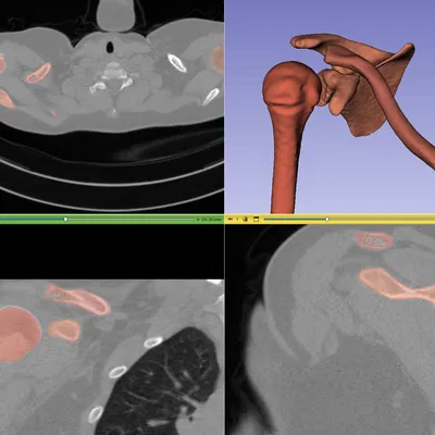 Xương Đòn Trái (Clavicle Left)
