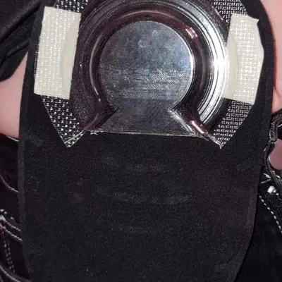 Nắp Giữ Tràng Ruột Sa / Prolapse Containment Cap for Intestinal Stoma