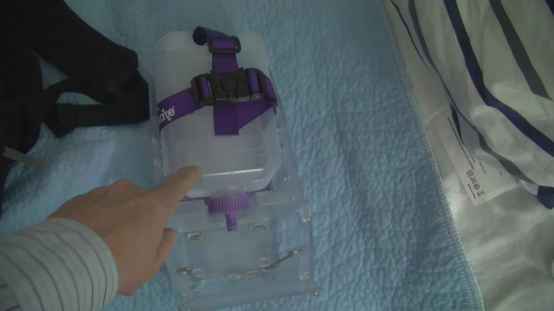 Vòng chêm chai PEG (Giving Set) – phương pháp đeo backpack - Image 1