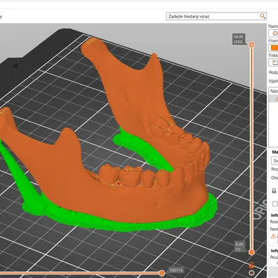 Mô Hình Quai Hàm Người 3D Giải Phẫu Tỉ Lệ 1:1 Từ CT Scan
