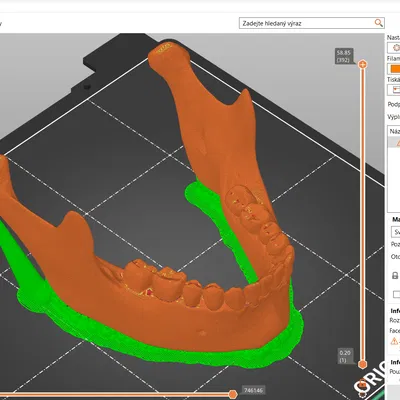 Mô Hình Quai Hàm Người 3D Giải Phẫu Tỉ Lệ 1:1 Từ CT Scan