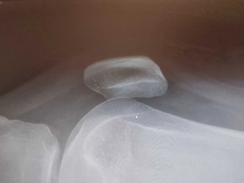 Mô hình 3D Xương Bánh Chè (Patella) - Được tạo từ hình ảnh X-quang thật! - Image 3