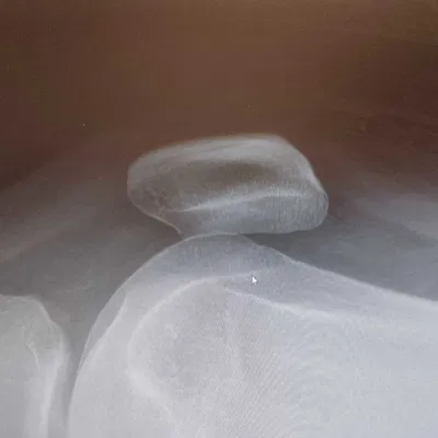 Mô hình 3D Xương Bánh Chè (Patella) - Được tạo từ hình ảnh X-quang thật!