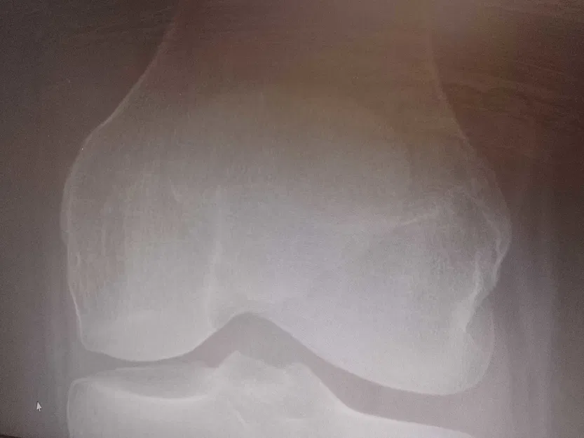 Mô hình 3D Xương Bánh Chè (Patella) - Được tạo từ hình ảnh X-quang thật! - Image 4