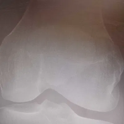 Mô hình 3D Xương Bánh Chè (Patella) - Được tạo từ hình ảnh X-quang thật!