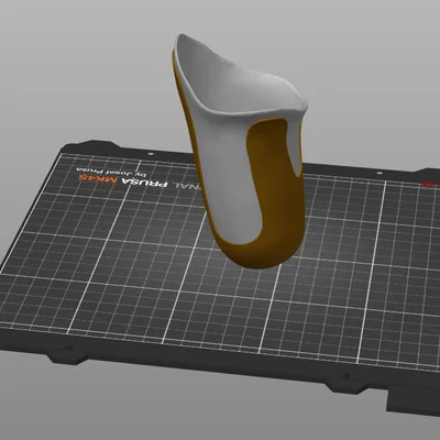 Socket chân giả transfemoral (trên gối) dạng single-walled