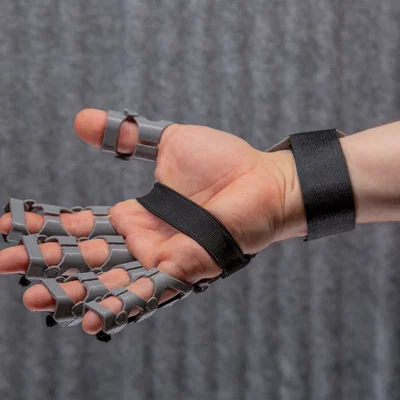 Orthosis in 3D FDM hỗ trợ phục hồi bàn tay co cứng, cải thiện vận động tinh