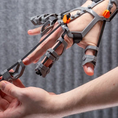 Orthosis in 3D FDM hỗ trợ phục hồi bàn tay co cứng, cải thiện vận động tinh
