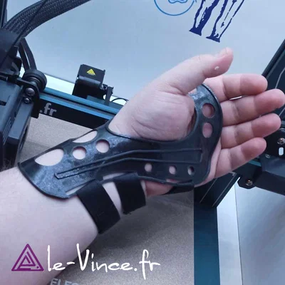 Nẹp cổ tay hỗ trợ in 3D tùy chỉnh (Wrist Orthosis)