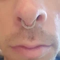 Nút chặn mũi in 3D hỗ trợ người mắc hội chứng mũi trống - Thumbnail 2