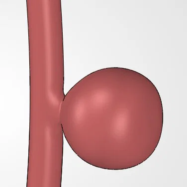Mô hình 3D phình động mạch dạng túi (Saccular Aneurysm) giáo dục