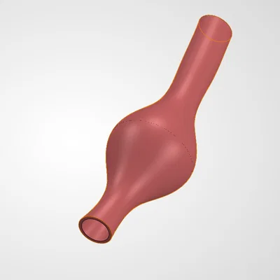 Mô hình phình động mạch hình thoi (Fusiform Aneurysm) in 3D