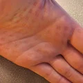 Thanh tạo cảm giác đau (Pain Stim Stick) hỗ trợ tâm lý - Thumbnail 3